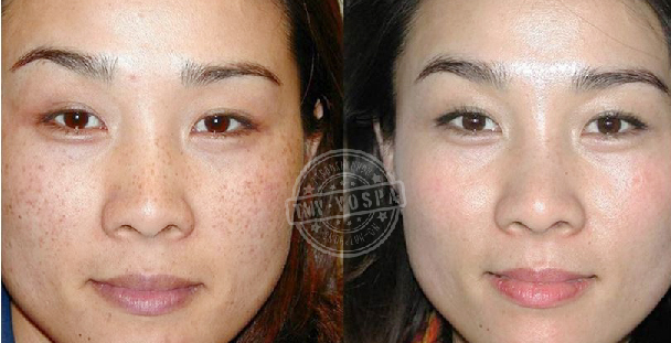 Trị nám da công nghệ cao Laser Toning